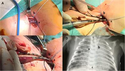 Surgical Expertise in Neonatal Extracorporeal Membrane Oxygenation (ECMO): A Single Center Experience